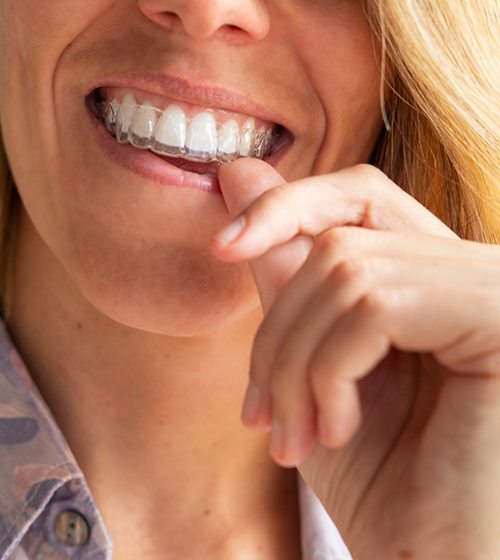 Close-up of adult woman’s smile with Invisalign aligner