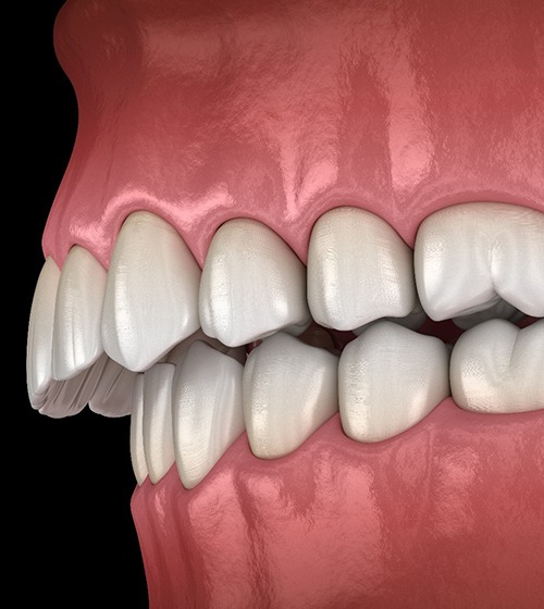 Illustration of overbite orthodontic problem against black background