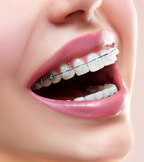 Closeup of teeth with clear braces