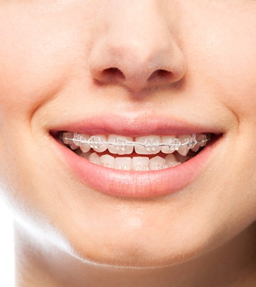 Young woman with ceramic braces