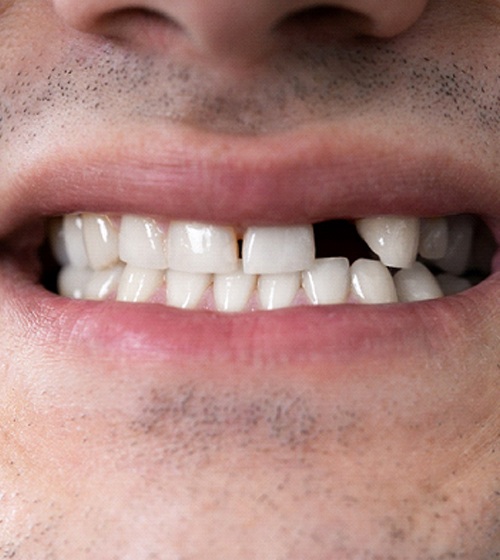 a person smiling with a missing tooth