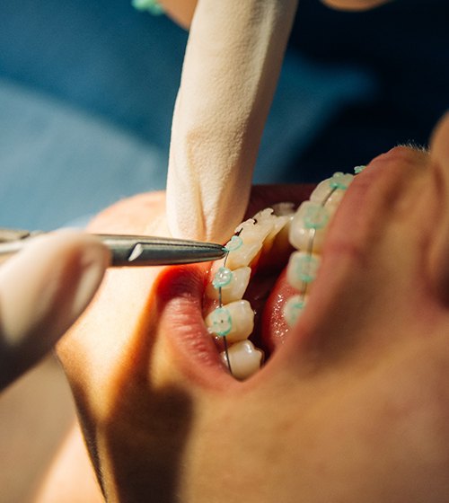 An orthodontist threading a metal wire through a patient’s brackets