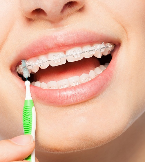 A woman using an interdental brush to clean between her brackets and underneath her metal wire