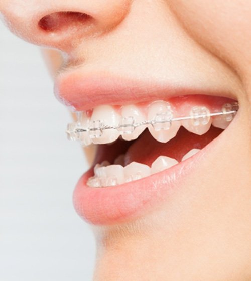 A young woman smiling and showing off her braces in Richardson