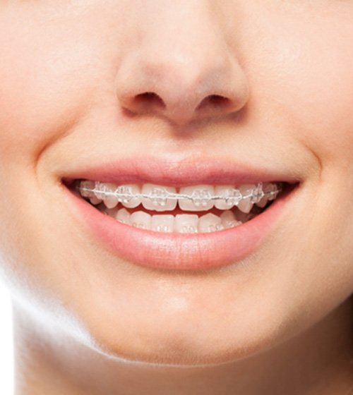 A young woman holding a clear Invisalign aligner and smiling