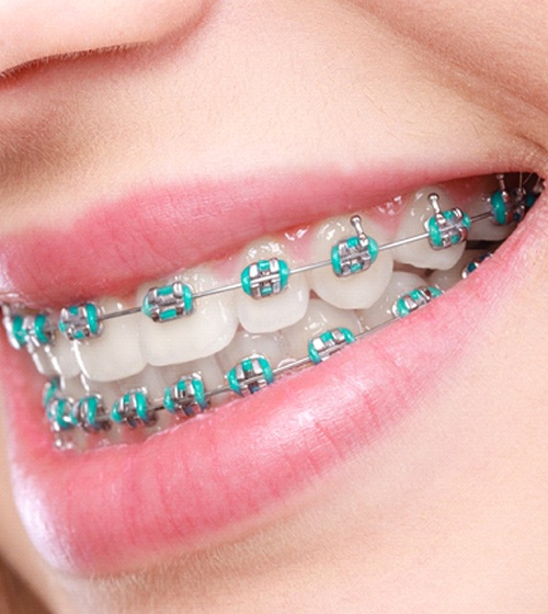 An up-close image of a person’s teeth complete with metal braces placed by an orthodontist in Richardson