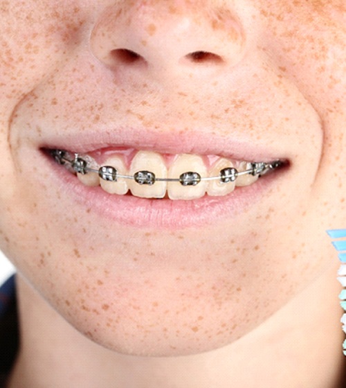 A young child with metal braces holding a toothbrush and an interdental brush