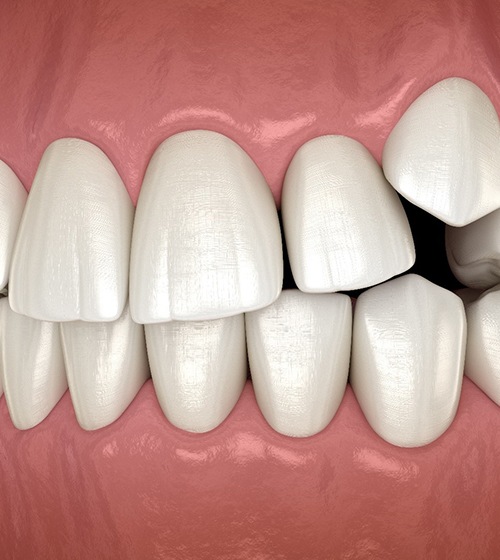 Illustration of crowded teeth in upper dental arch