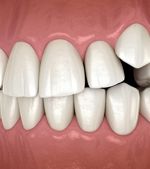 Illustration of crowded teeth in upper dental arch
