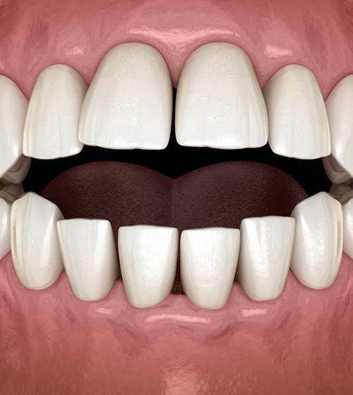 Close-up, 3D Illustration of open bite orthodontic problem