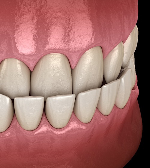 3D illustration of underbite