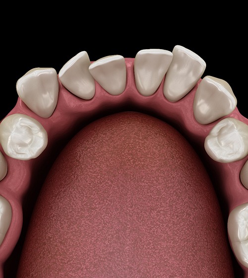 3D illustration of crooked teeth