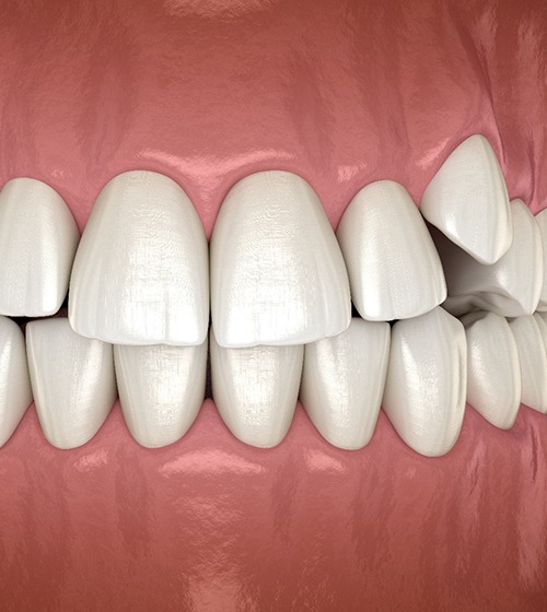 3D illustration of impacted teeth 