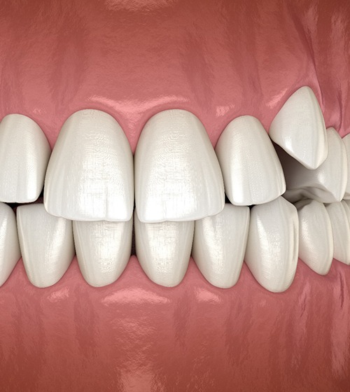 3D illustration of impacted teeth