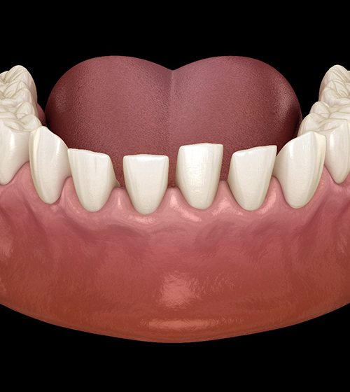 3D illustration of gaps between teeth 