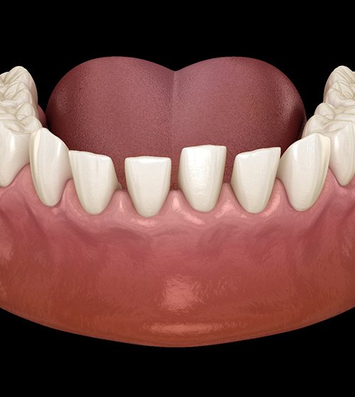 3D illustration of gaps between teeth