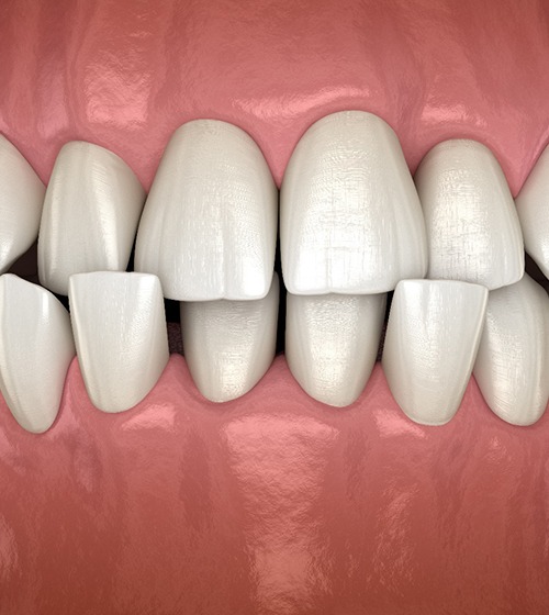 3D illustration of crossbite