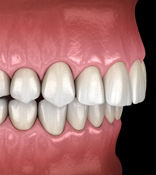 3D illustration of overbite