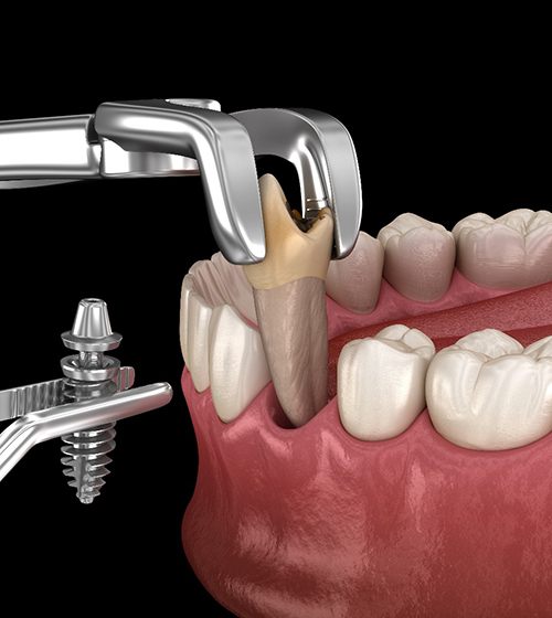 3D illustration of orthodontic extraction