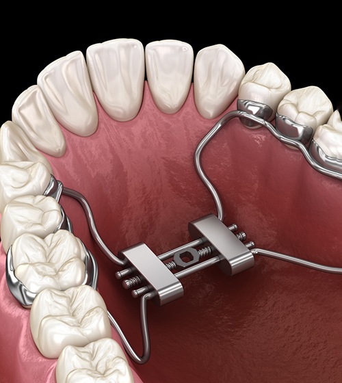 Angled illustration of palatal expander in Richardson