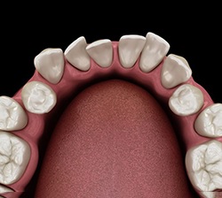 Illustration of crowded teeth viewed from above