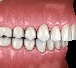 Illustration of overbite against dark background