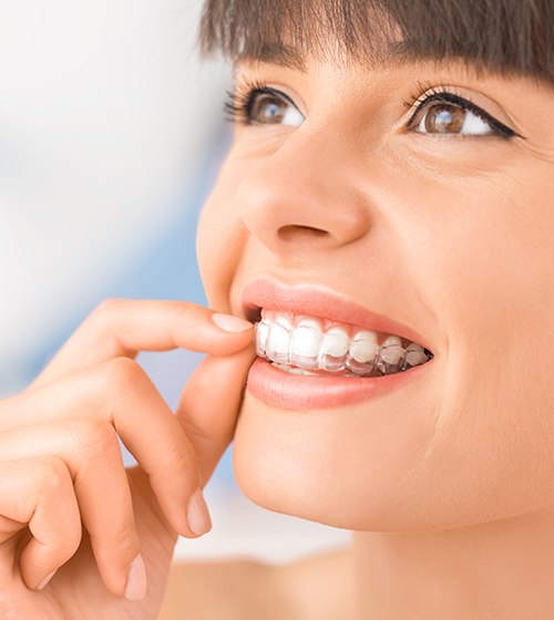A female teenager smiling and inserting a clear aligner into her mouth after eating