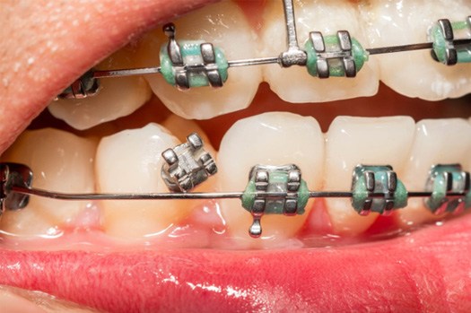 Closeup of a broken bracket