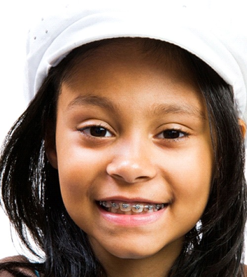 A young girl wearing a white hat and smiling, showing off her metal braces on her upper teeth after seeing an orthodontist in Richardson