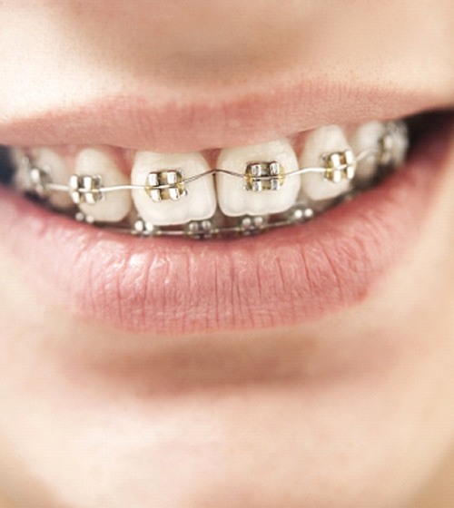 An up-close image of metal braces on a child’s upper and lower teeth