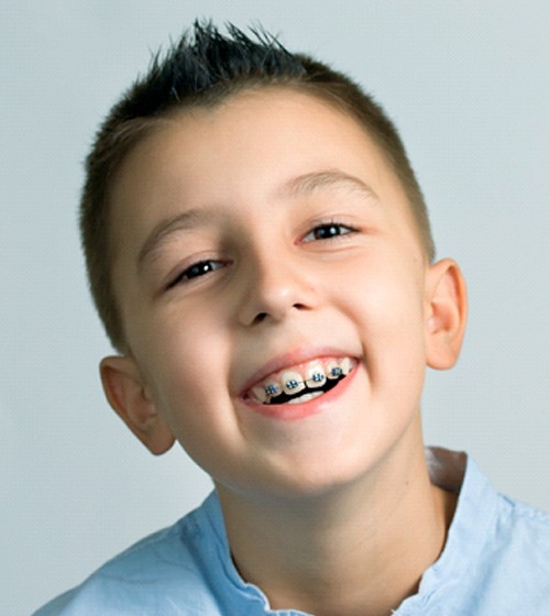 A young boy smiling while his metal braces are showing on his upper teeth