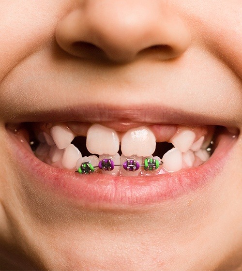 Closeup of smile with phase 1 orthodontics