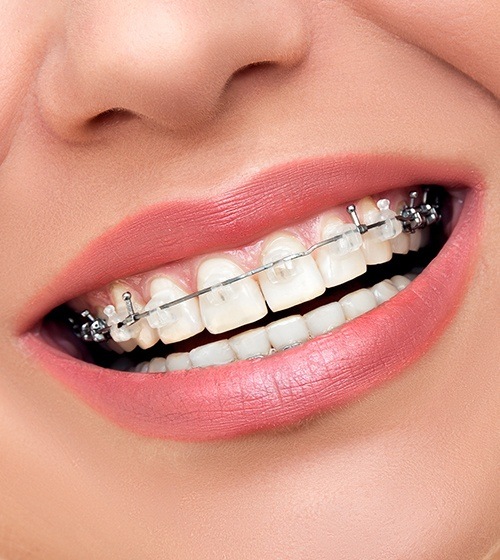Closeup of teeth with self-litigating braces