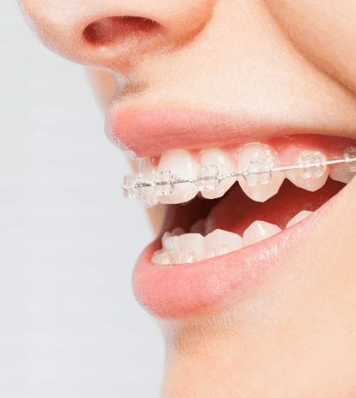 Closeup of smile with tooth-colored orthodontic brackets