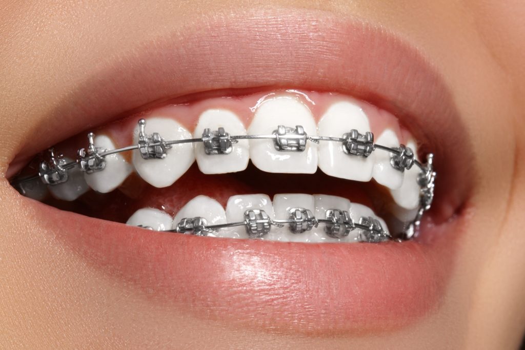 Closeup of woman smiling with traditional braces