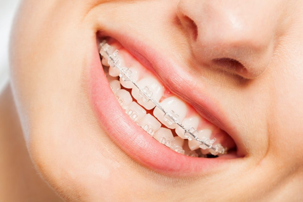 Closeup of woman with braces smiling