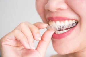 Woman sliding Invisalign aligner onto her teeth