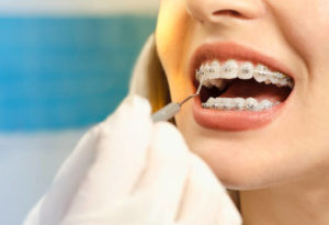 Close up of woman’s teeth with braces