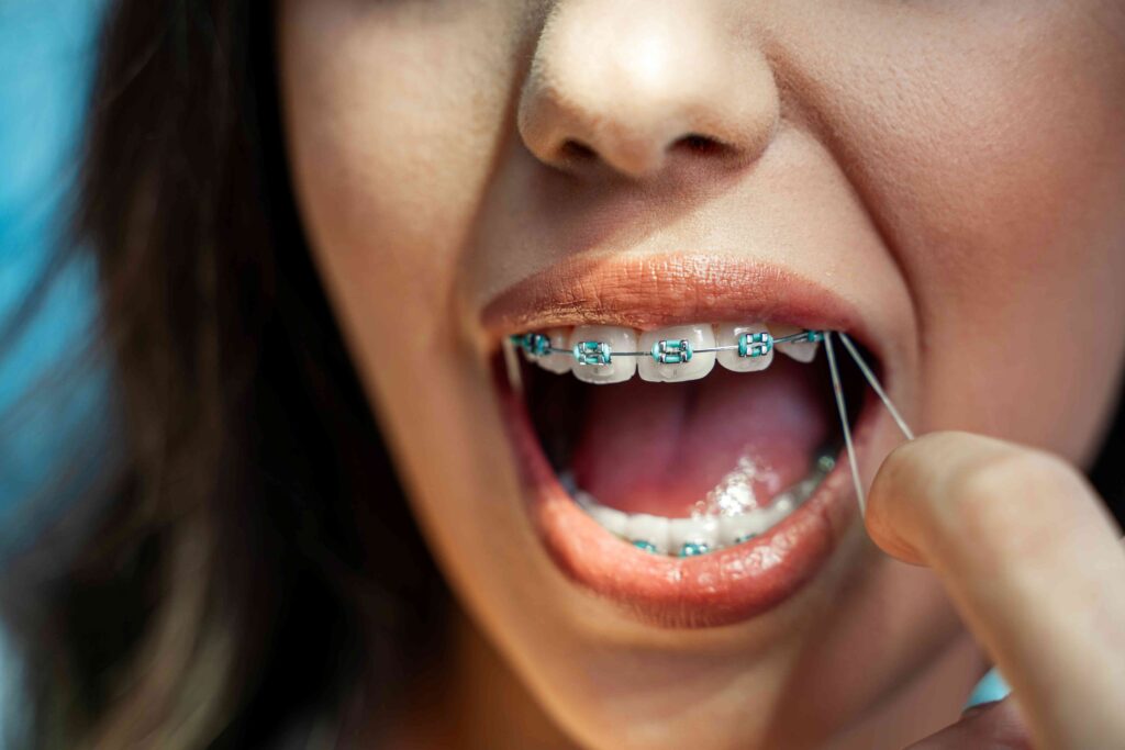 Woman with rubber bands on her braces
