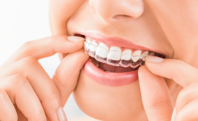 woman inserting Invisalign aligner into her mouth
