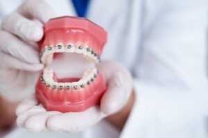 Plastic model of mouth with braces on the teeth.