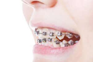 Close-up of woman’s smile with self-ligating braces